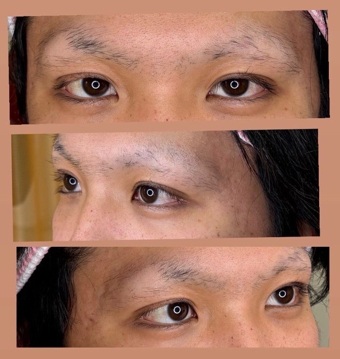 20代男性 まゆ施術前の写真
